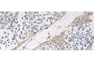 Immunohistochemistry of paraffin-embedded Human tonsil tissue using GBA Polyclonal Antibody at dilution of 1:55(x200) (GBA 抗体)