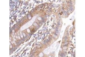 ABIN6277128 at 1/200 staining Human colon cancer tissue sections by IHC-P. (REG3g 抗体)