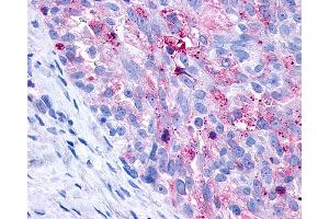 Anti-P2Y10 / P2RY10 antibody IHC of human Ovary, Carcinoma. (P2RY10 抗体  (C-Term))