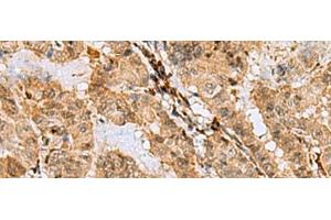 Immunohistochemistry of paraffin-embedded Human thyroid cancer tissue using ASNA1 Polyclonal Antibody at dilution of 1:70(x200) (ASNA1 抗体)