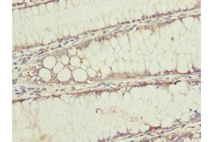 Immunohistochemistry of paraffin-embedded human colon cancer using ABIN7159902 at dilution of 1:100