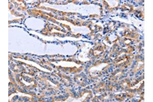 The image on the left is immunohistochemistry of paraffin-embedded Human thyroid cancer tissue using ABIN7191274(LIF Antibody) at dilution 1/25, on the right is treated with synthetic peptide. (LIF 抗体)