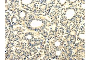 The image on the left is immunohistochemistry of paraffin-embedded Human thyroid cancer tissue using ABIN7131302(TBC1D22A Antibody) at dilution 1/25, on the right is treated with fusion protein. (TBC1D22A 抗体)