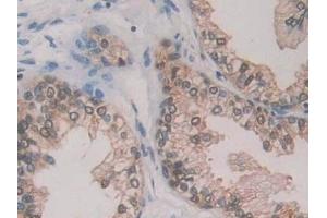 Detection of GR in Human Prostate Tissue using Polyclonal Antibody to Glutathione Reductase (GR) (Glutathione Reductase 抗体  (AA 44-522))
