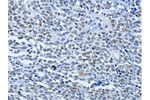 The image on the left is immunohistochemistry of paraffin-embedded Human ovarian cancer tissue using ABIN7190072(CBX1 Antibody) at dilution 1/30, on the right is treated with synthetic peptide. (CBX1 抗体)