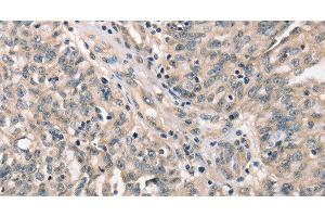 Immunohistochemistry of paraffin-embedded Human ovarian cancer tissue using CDK12 Polyclonal Antibody at dilution 1:30 (CDK12 抗体)