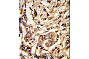 Formalin-fixed and paraffin-embedded human breast carcinoma reacted with GALT Antibody , which was peroxidase-conjugated to the secondary antibody, followed by DAB staining. (GALT 抗体  (C-Term))