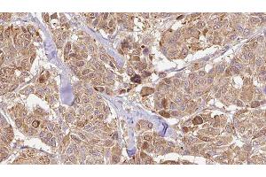 ABIN6276495 at 1/100 staining Human Melanoma tissue by IHC-P.