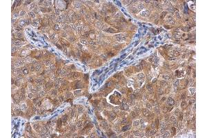 IHC-P Image ACTL8 antibody detects ACTL8 protein at cytoplasm in human lung cancer by immunohistochemical analysis. (Actin-Like 8 抗体)