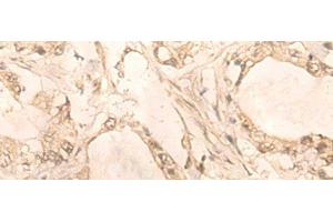 Immunohistochemistry of paraffin-embedded Human gastric cancer tissue using PLEKHA1 Polyclonal Antibody at dilution of 1:30(x200) (PLEKHA1 抗体)