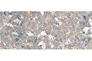 Immunohistochemistry of paraffin-embedded Human liver cancer tissue using CXCR5 Polyclonal Antibody at dilution of 1:80(x200) (CXCR5 抗体)