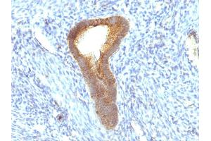 Formalin-fixed, paraffin-embedded human Endometrial Carcinoma stained with Alkaline Phosphatase Mouse Monoclonal Antibody (ALPL/597). (ALPL 抗体)