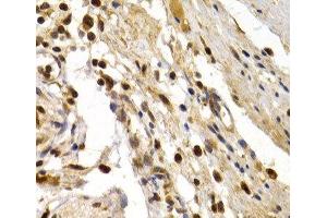 Immunohistochemistry of paraffin-embedded Human colon damage using TFDP1 Polyclonal Antibody at dilution of 1:200 (40x lens). (DP1 抗体)