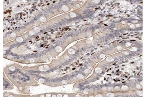 ABIN6266583 at 1/100 staining human colon carcinoma tissue sections by IHC-P. (SCGB2A1 抗体  (Internal Region))