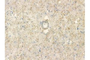 ABIN7093862 and ABIN7097905 at 1/100 staining human astrocytoma by IHC-P.