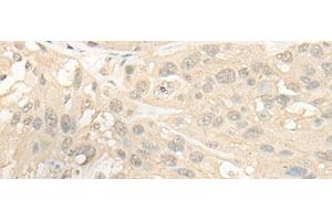 Immunohistochemistry of paraffin-embedded Human esophagus cancer tissue using CYP4X1 Polyclonal Antibody at dilution of 1:40(x200) (CYP4X1 抗体)