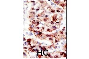 Formalin-fixed and paraffin-embedded human cancer tissue reacted with the primary antibody, which was peroxidase-conjugated to the secondary antibody, followed by AEC staining. (Ubiquitin 抗体  (AA 36-66))