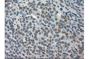 Immunohistochemical staining of paraffin-embedded Adenocarcinoma of breast tissue using anti-TRIB2 mouse monoclonal antibody. (TRIB2 抗体)