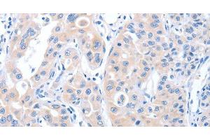 Immunohistochemistry of paraffin-embedded Human lung cancer tissue using ARHGEF6 Polyclonal Antibody at dilution 1:70 (ARHGEF6 抗体)