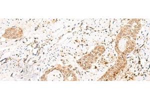 Immunohistochemistry of paraffin-embedded Human esophagus cancer tissue using PRKAG2 Polyclonal Antibody at dilution of 1:55(x200) (PRKAG2 抗体)