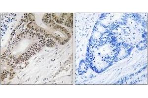 Immunohistochemistry analysis of paraffin-embedded human colon carcinoma tissue, using FOXO3A (Ab-315) Antibody. (FOXO3 抗体  (AA 281-330))