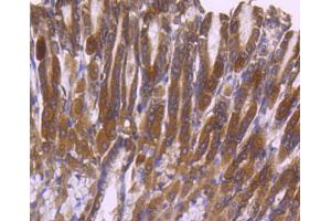 Paraformaldehyde-fixed, paraffin embedded Human breast carcinoma, Antigen retrieval by boiling in sodium citrate buffer (pH6) for 15min, Block endogenous peroxidase by 3% hydrogen peroxide for 30 minutes, Blocking buffer at 37°C for 20min, Antibody incubation with ERK2 (3G1) Monoclonal Antibody  at 1:50 overnight at 4°C, followed by a conjugated secondary and DAB staining. (ERK2 抗体)