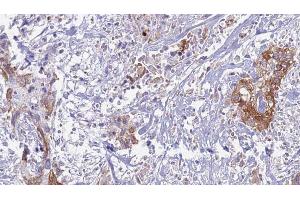 ABIN6269237 at 1/100 staining Human urothelial cancer tissue by IHC-P. (CD130/gp130 抗体  (C-Term))