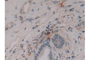 Detection of DNM2 in Human Liver cancer Tissue using Polyclonal Antibody to Dynamin 2 (DNM2) (DNM2 抗体  (AA 533-731))