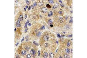 Immunohistochemical analysis of MPP2 staining in human liver cancer formalin fixed paraffin embedded tissue section. (MPP2 抗体)
