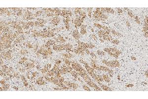 Immunohistochemistry (IHC) image for anti-Cadherin 1, Type 1, E-Cadherin (Epithelial) (CDH1) (N-Term) antibody (ABIN7538881)