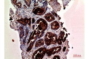Immunohistochemistry (IHC) analysis of paraffin-embedded Human Prostate Cancer, antibody was diluted at 1:100. (Prostate Specific Antigen 抗体  (Internal Region))