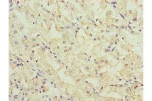 Immunohistochemistry of paraffin-embedded human gastric cancer using ABIN7147407 at dilution of 1:100 (CEP44 抗体  (AA 1-280))