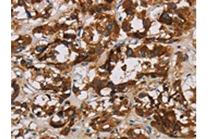 The image is immunohistochemistry of paraffin-embedded Human thyroid cancer tissue using ABIN7128636(BCL2L12 Antibody) at dilution 1/20. (BCL2L12 抗体)