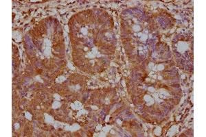 IHC image of ABIN7139920 diluted at 1:200 and staining in paraffin-embedded human colon cancer performed on a Leica BondTM system. (LPAR6 抗体  (AA 292-313))