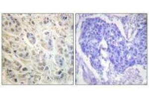 Immunohistochemistry analysis of paraffin-embedded human colon carcinoma tissue using p90 RSK (Ab-573) antibody. (RPS6KA1 抗体  (Thr573))