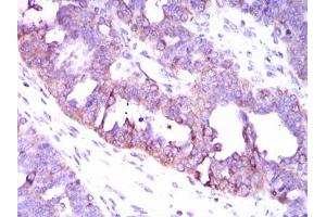 Immunohistochemical analysis of paraffin-embedded ovarian cancer tissues using CAMK4 mouse mAb with DAB staining. (CAMK4 抗体  (AA 35-292))