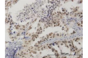 Immunoperoxidase of monoclonal antibody to HMG20B on formalin-fixed paraffin-embedded human lung cancer. (HMG20B 抗体  (AA 1-109))