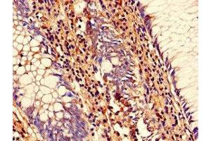 Immunohistochemistry of paraffin-embedded human colon cancer using ABIN7168833 at dilution of 1:100 (SENP1 抗体  (AA 63-214))