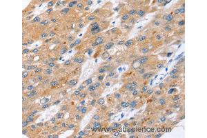 Immunohistochemistry of Human liver cancer using ERVW-1 Polyclonal Antibody at dilution of 1:45 (ERVW-1 抗体)
