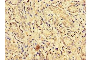 Immunohistochemistry of paraffin-embedded human gastric cancer using ABIN7151827 at dilution of 1:100 (EPHA1 抗体  (AA 296-414))