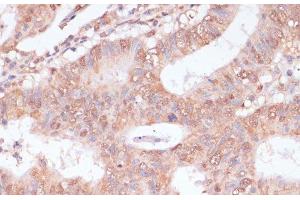 Immunohistochemistry of paraffin-embedded Human colon carcinoma using BYSL Polyclonal Antibody at dilution of 1:100 (40x lens). (Bystin-Like 抗体)