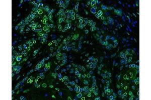 IF analysis of Emerin using anti-Emerin antibody (ABIN4886569) Emerin was detected in paraffin-embedded section of human oesophagus squama cancer tissues.