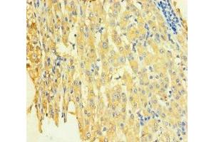 Immunohistochemistry of paraffin-embedded human liver cancer using ABIN7171249 at dilution of 1:100 (STX8 抗体  (AA 1-215))