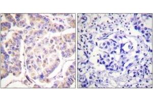 Immunohistochemistry analysis of paraffin-embedded human breast carcinoma tissue, using SYK (Ab-525) Antibody. (SYK 抗体  (AA 491-540))