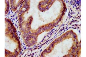 IHC image of ABIN7160339 diluted at 1:300 and staining in paraffin-embedded human endometrial cancer performed on a Leica BondTM system. (MEGF9 抗体  (AA 49-178))
