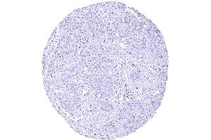 Muscle invasive urothelial carcinoma of the urinary bladder. (Recombinant NFIX 抗体  (Center))