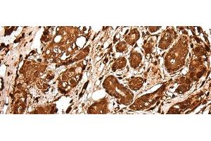 Immunohistochemistry of paraffin-embedded Human breast cancer tissue using VCP Polyclonal Antibody at dilution of 1:30(x200) (VCP 抗体)