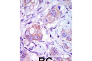 Formalin-fixed and paraffin-embedded human cancer tissue reacted with the primary antibody, which was peroxidase-conjugated to the secondary antibody, followed by DAB staining. (MAP3K9 抗体  (C-Term))