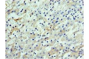 Immunohistochemistry of paraffin-embedded human liver cancer using ABIN7147929 at dilution of 1:100 (CSTF2 抗体  (AA 1-180))