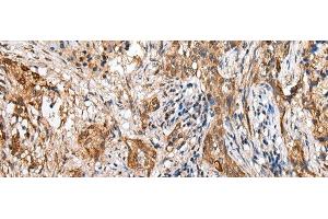 Immunohistochemistry of paraffin-embedded Human lung cancer tissue using LYPD4 Polyclonal Antibody at dilution of 1:25(x200) (LYPD4 抗体)